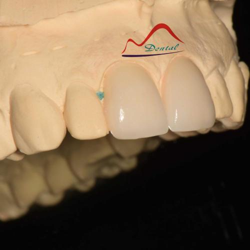 Dental Aesthetic Porcelain Veneers