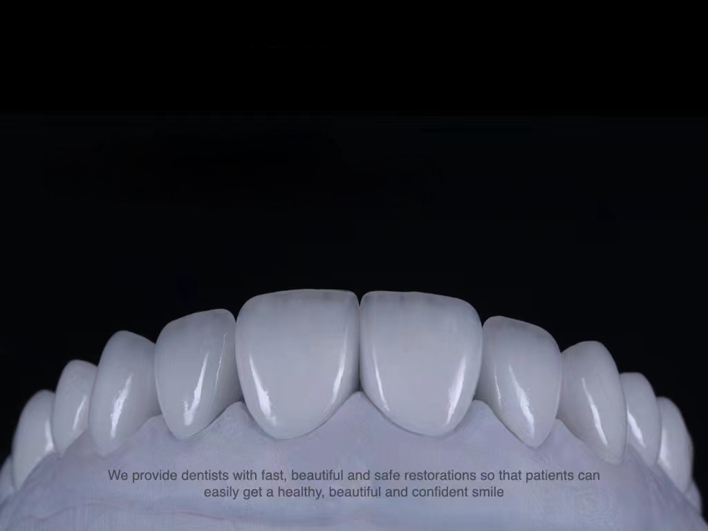 Lanciata impiallacciatura in porcellana Cast Porcelain Veneers