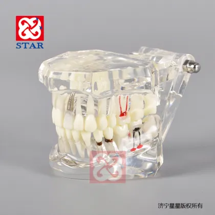 Pathological Dental Implant Restoration Model for Demonstration