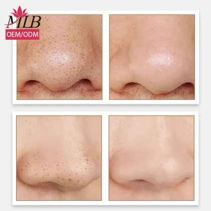 Nose Blackhead Remover and Pore Cleaning Mask