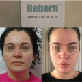 Reborn Age Restore Dermal Filler For Marionette Lines