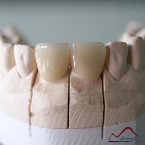 Customized CC Cosmetic Veneer