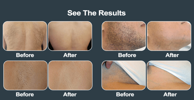 Display Screen Handle laser hair removal portable 3 wave length 755 1064 808 diode laser hair removal machine