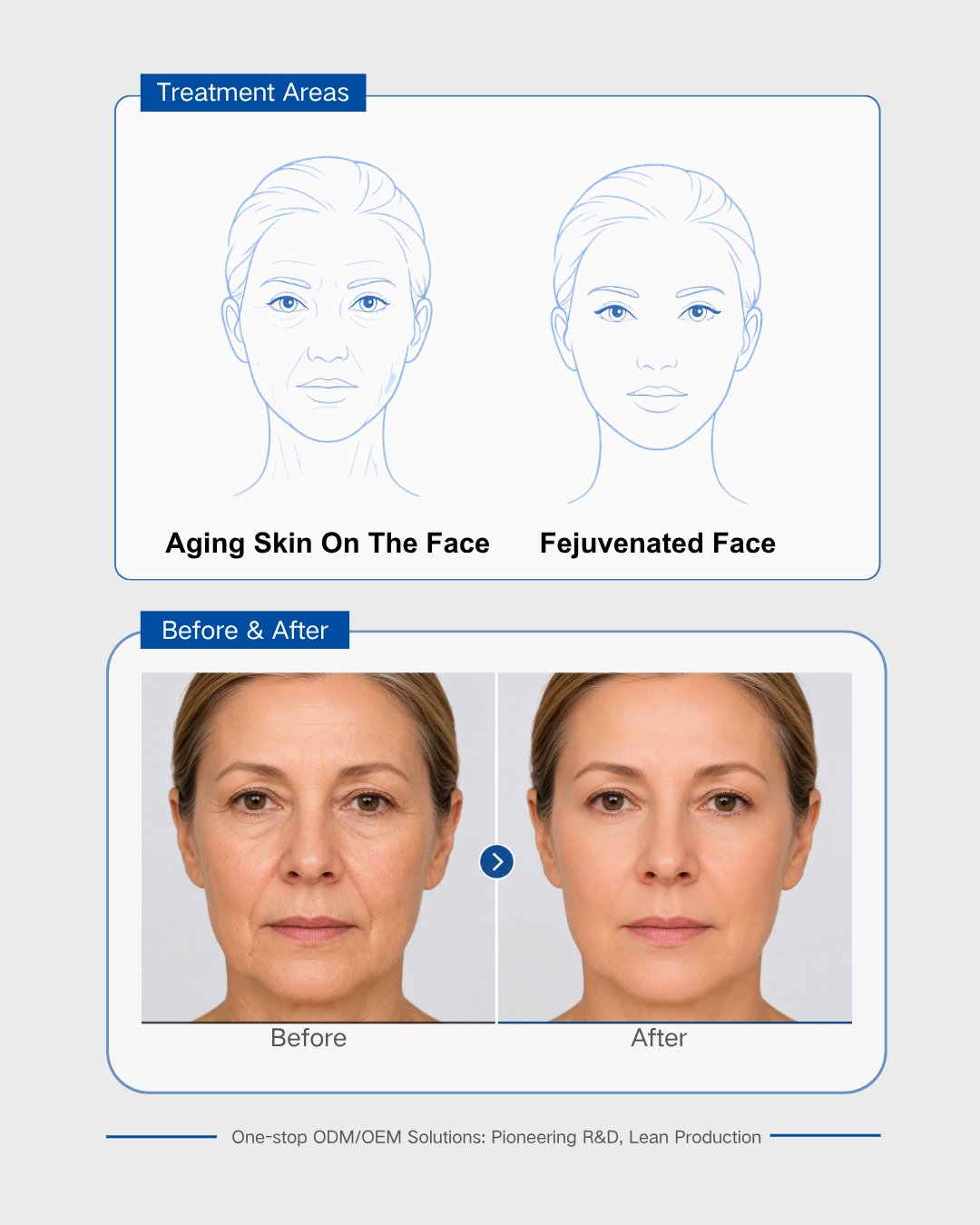 Transducer – A Key Component of Facial Rejuve