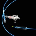 Medical 3-stage Dilation Balloon Catheter