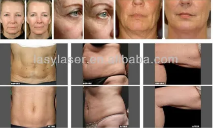 Freeze fats system handle vacuum slimming massager