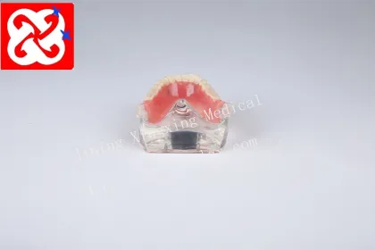 Mandibular Overdenture Restoration with 2 Implants