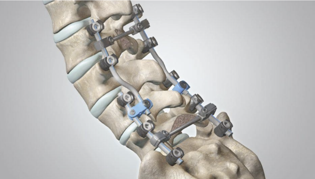 Spine trauma implant parts