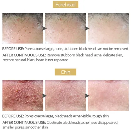 Bamboo Charcoal Blackhead Remover Nose Mask