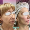 Wrinkle Removal Injectable Dermal Filler For Forehead Lines