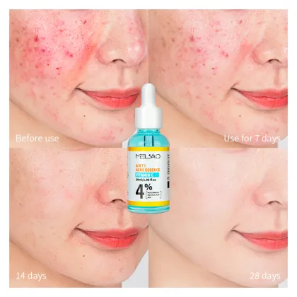 Anti Acne treatment Pimple Remover Serum