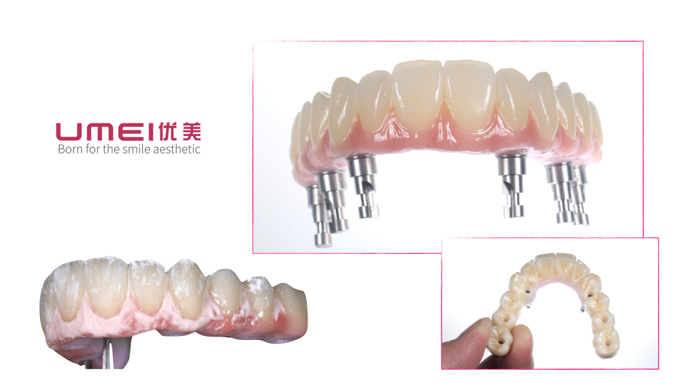 Zirconia Bridge