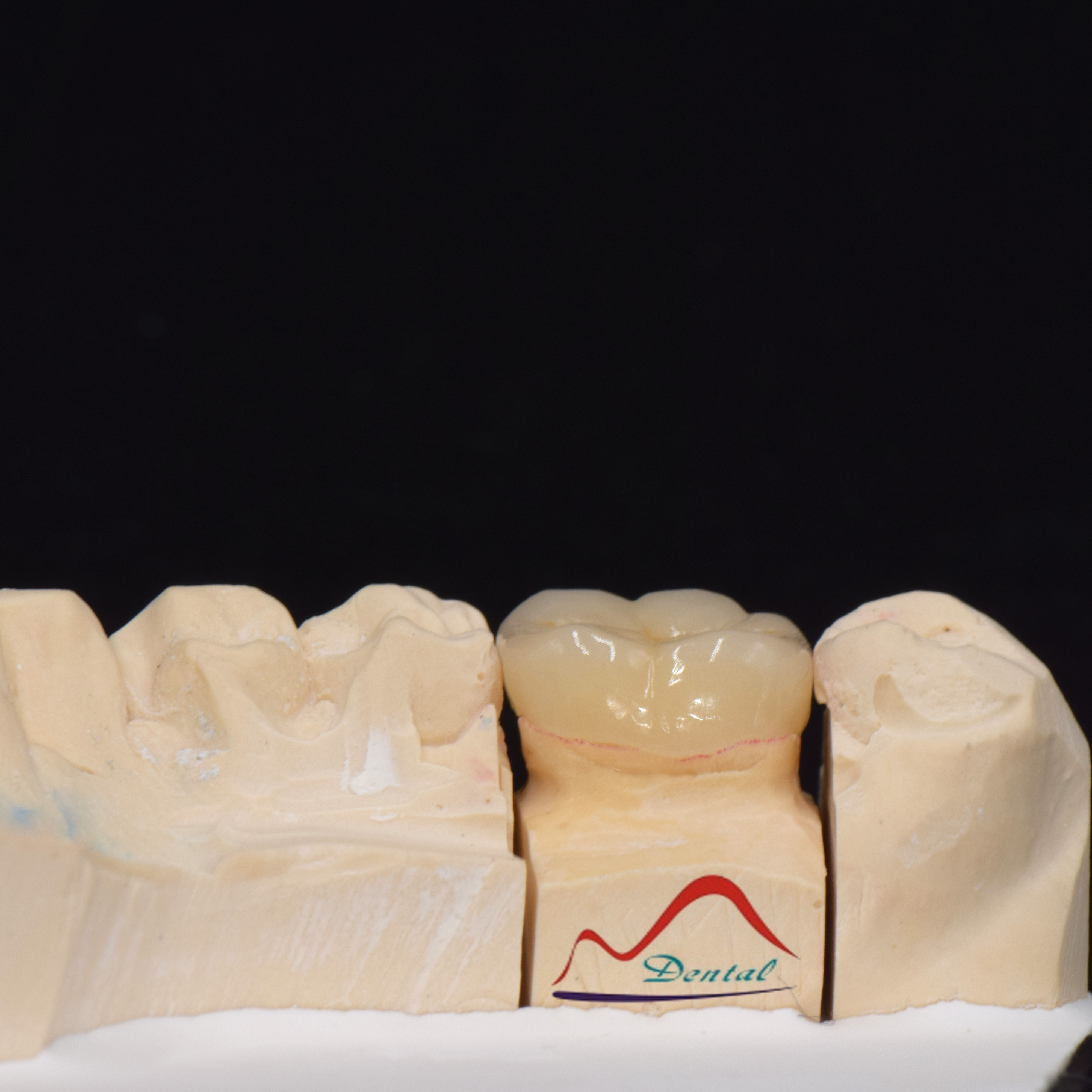 Posterior IPS e.max Press Prosthesis c