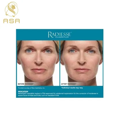 Radiesse 1.5cc Skin Booster Dermal Filler