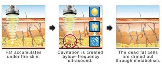 rf cavitation machine
