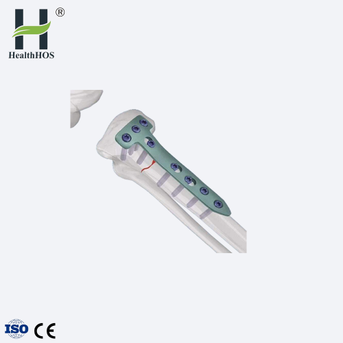 Tibia proximal osteotomy ด้านข้างแผ่นล็อครูปตัว T