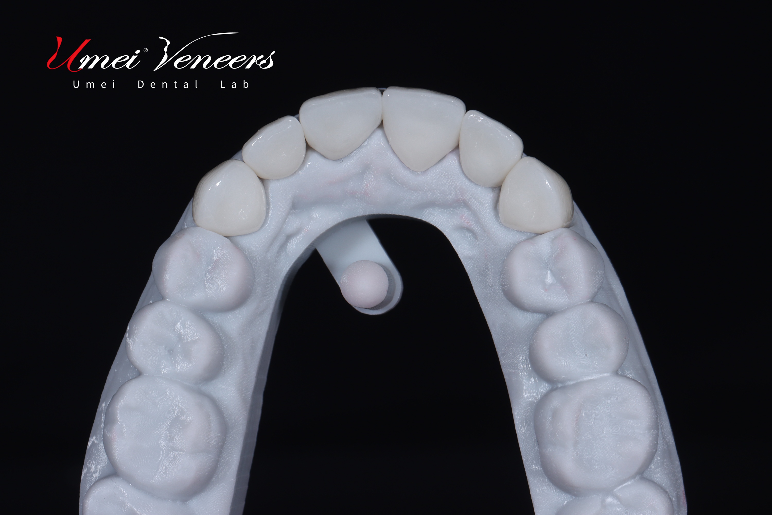 Hollywood White Veneers