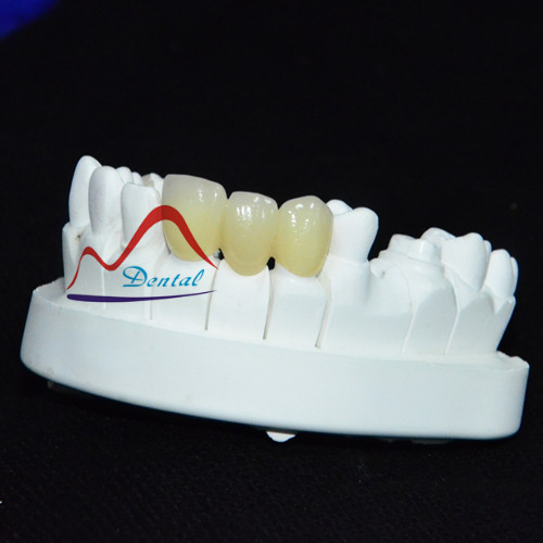 Dental Layered Zirconia crowns