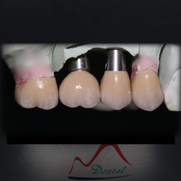Delicate implant crown and bridge