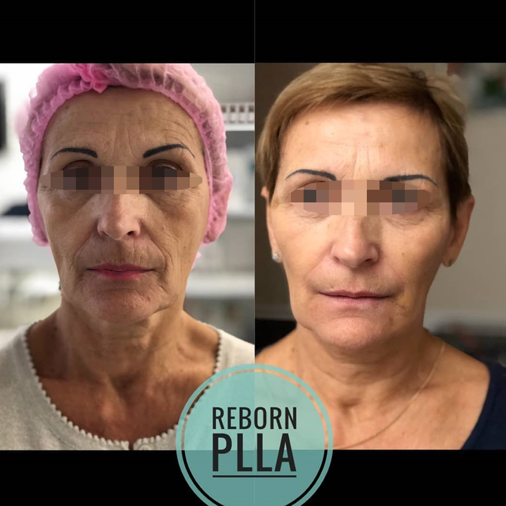 Dutrition Collagen Plus PLLA Dermal Filler