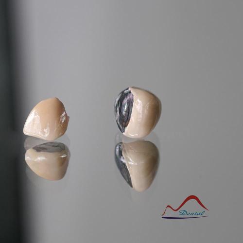 3/4 Porcelain Metal Crown