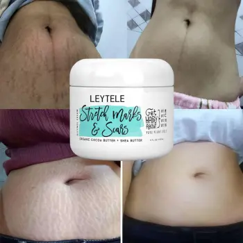 OEM ODM Natural Organic Postpartum Stretch Mark Removal Cream