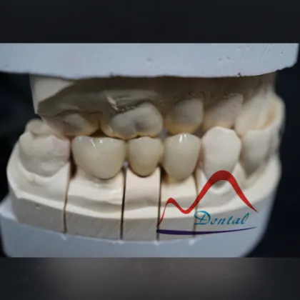Strong dental Precious PFM