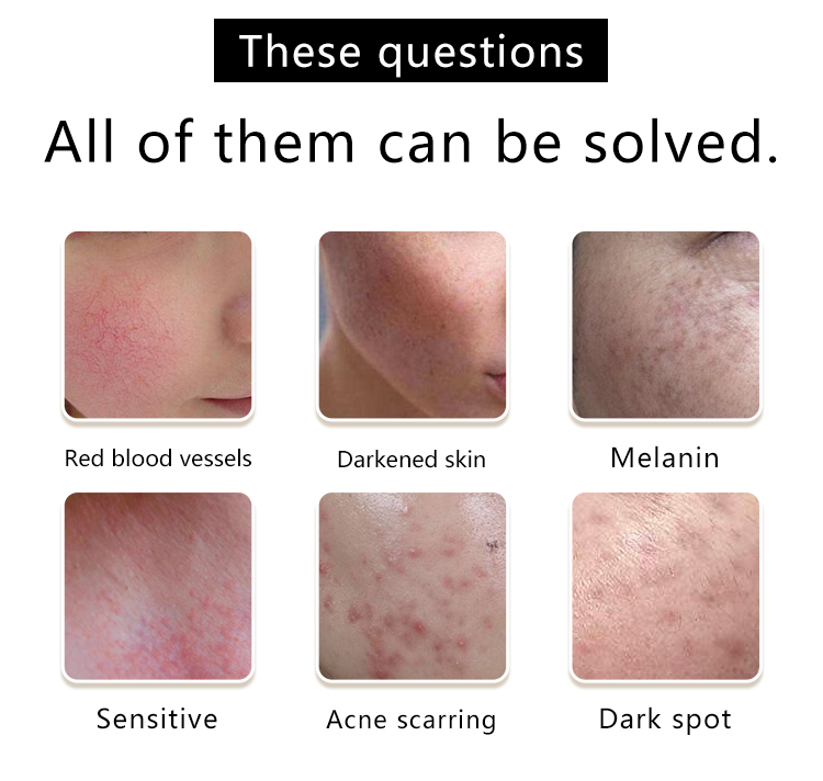 Best HIFU Machine for Skin Tightening