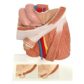 مدل فتق Inguinal