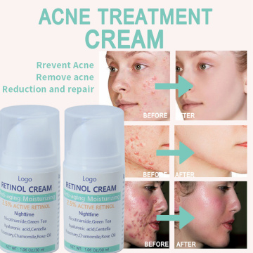 Creme para cicatrizes de acne Removedor de ponto escuro