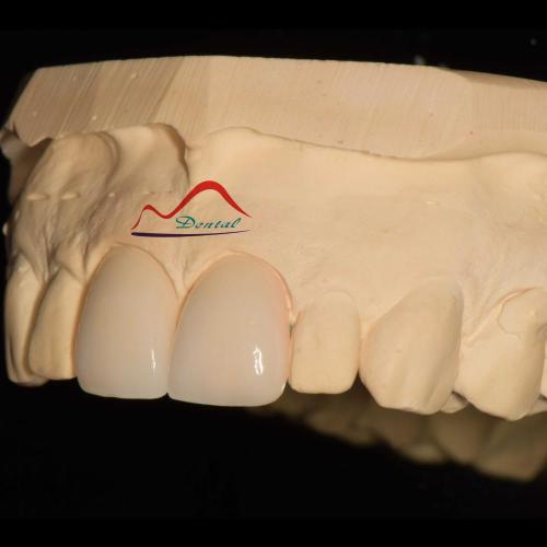 Dental Aesthetic Porcelain Veneers