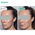 Stimulate Collagen Produce Dermal Filler