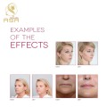 Neauvia Organic Hydro Mesotherapy Product Effective Amino Acids Stimulates Collagen Regeneration