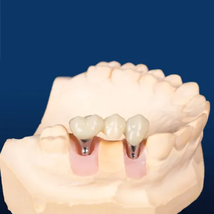Custom Abutment with Two Brand New Screws