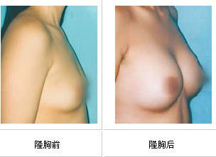 hyaluronic acid breast filler injection