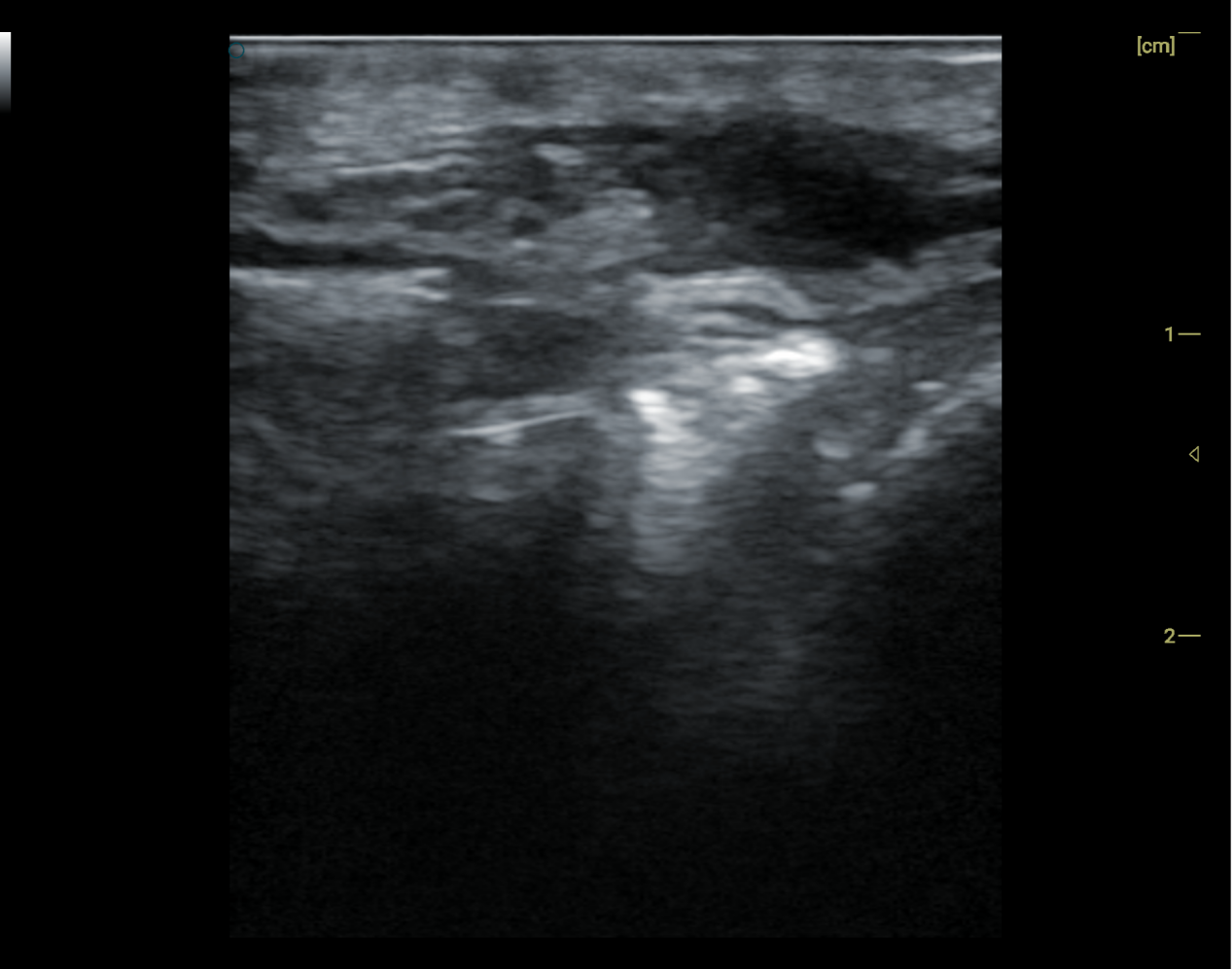 High-Frequency Handheld Ultrasound Probe – An