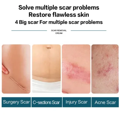 FEXMS Scar Removal Cream - 30g: Reduces Redness and Thickness, Improves Scar Appearance with Safe Ingredients
