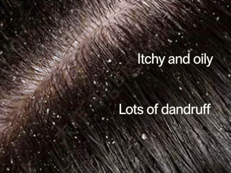 dandruff shampoo