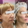 Professional Facial Skin Care Needling PLLA Dermal Filler