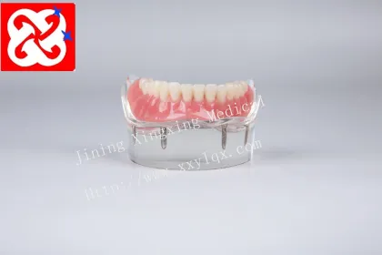 Mandibular Overdenture Implant Teeth Model with 4 Implants