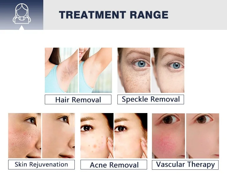 hair removal device