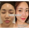 Cellofill Rejuve Revitalizing Booster Solution Cellofill Gp60 Pdrn Hyaluronic Acid Injection for Revitalizing Skin Elasti