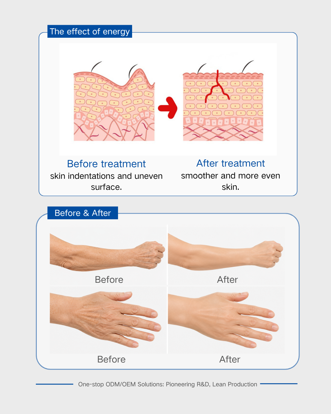 Focused Ultrasound Transducer for Forearm and