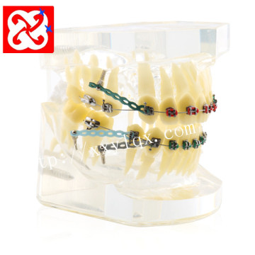 Transparent Orthodontic Treatment Demonstration Model with Braces and Ligature Wire