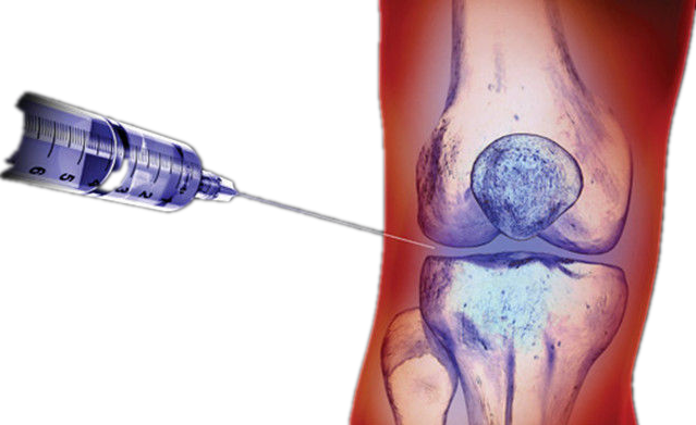 Hyaluronic Acid Injections