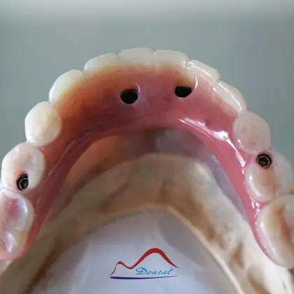 All-On-Four Dental Implant Restoration