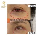 Sterile Ampoule Gene Peptide Allsensa Dark Circle Solution Eye Bag Wrinkle Removal