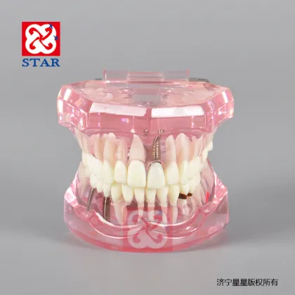 Pathological Dental Implant Restoration Model for Demonstration