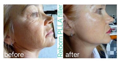 dermal filler before and after