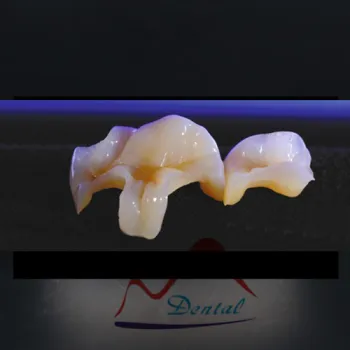 IPS E.max® inlay and onlay placed on decayed tooth